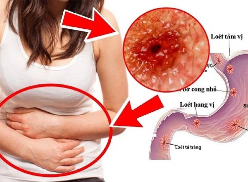 Máy lọc nước cho người bị bệnh dạ dày nên chọn như thế nào?